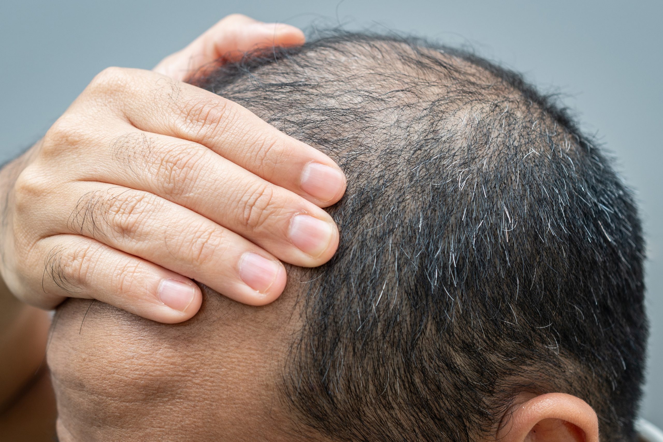 Baldness is usually most noticeable on the scalp, but it can happen anywhere on the body where hair grows.